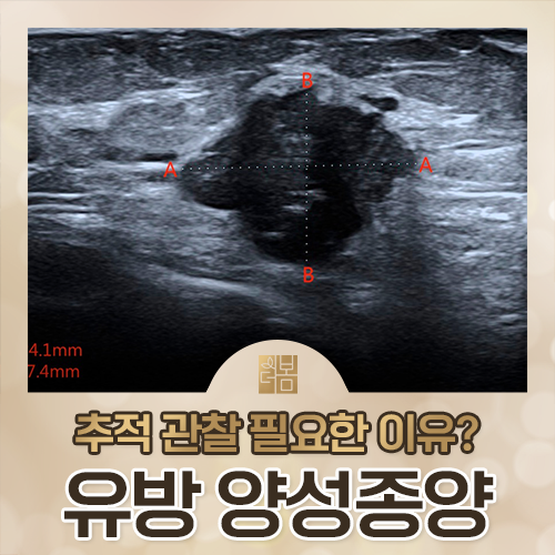 유방초음파에서 발견된 양성 종양, 그래도 추적 검사가 필요한 이유는?